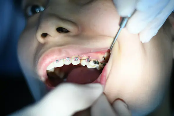 Aparelho ortodôntico e alinhamento dental